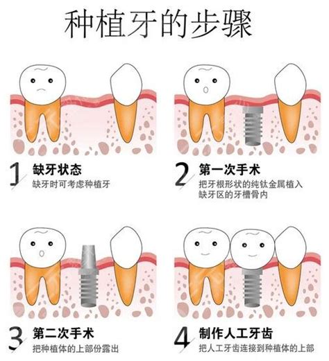 种植牙多少钱一颗2024价格表公布收费标准平均值了解一下 城市惠口腔