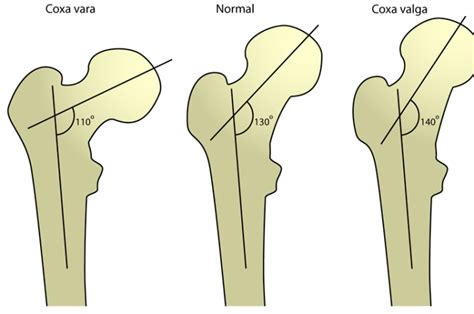 Coxa Vara Causes and Treatment | Bone and Spine