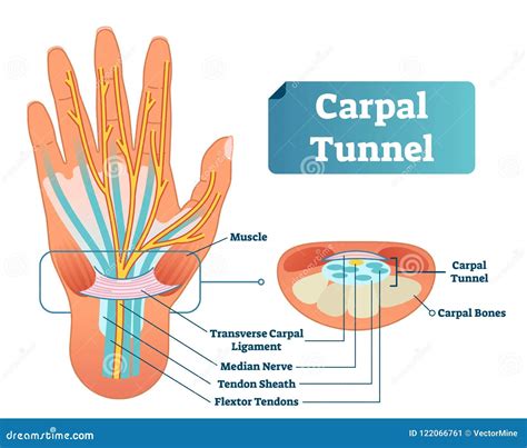 Carpal Tunnel Syndrome Concept Icon Cartoon Vector