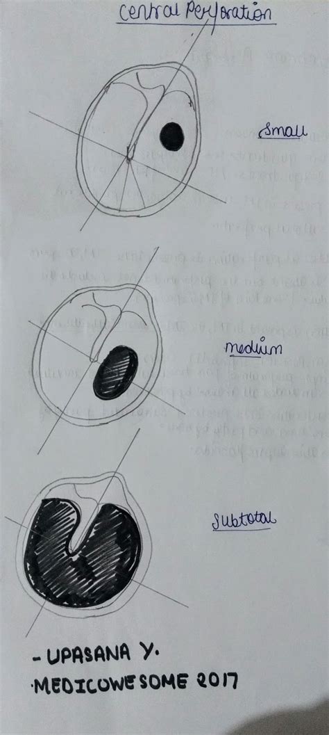 Medicowesome: Types of tympanic membrane perforation