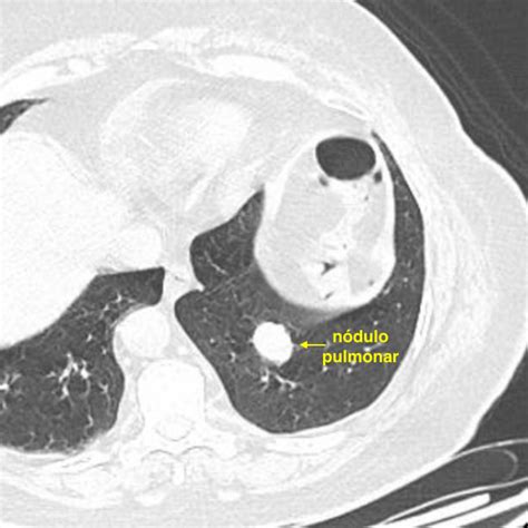 Abla O De Tumor De Pulm O O Que E Quando Est Indicado