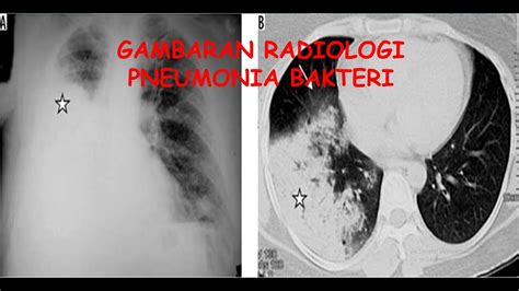 Gambaran Radiologi Pneumonia Part 1 Pneumonia Bakterirontgen Radang