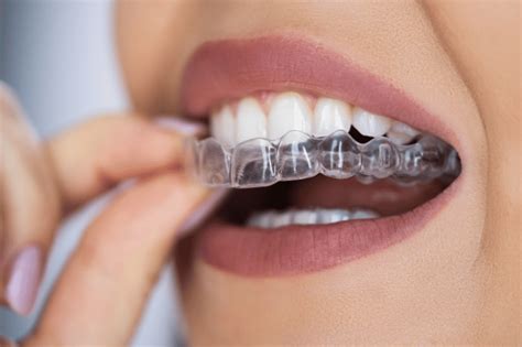 How Clear Aligners Work Your Step By Step Guide To A Straighter Smile