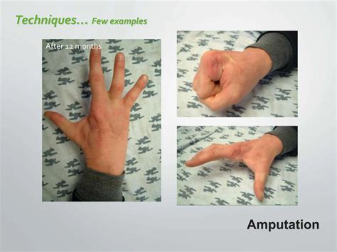 amputation orthopedics mbbs with types.pptx