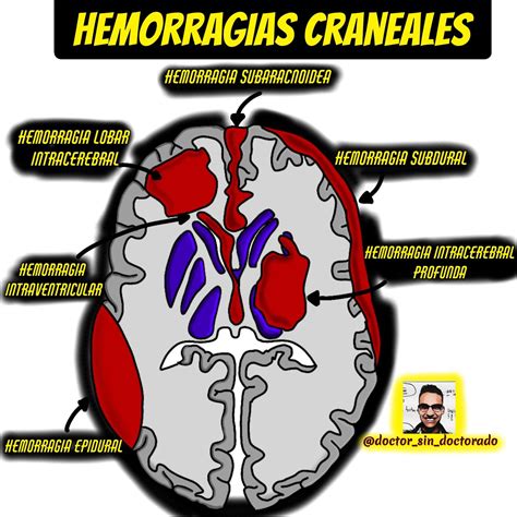 Principales Tipos De Hemorragias Craneales Anatomy Medicine Knowledge