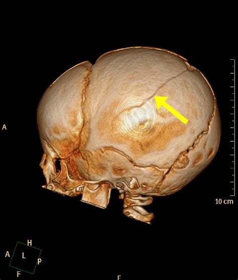 3d Reconstruction Image Of A Computed Tomography Scan Of The Head