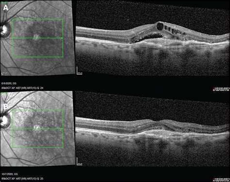 Retinal Physician Pentavision