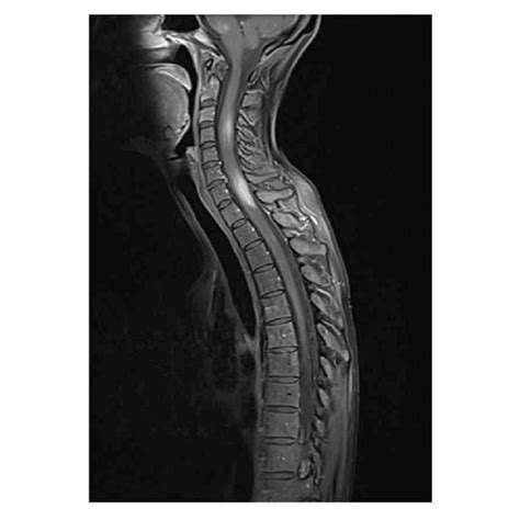 Hyperintense Lesions In Medulla Oblongata And In Cervical And Upper