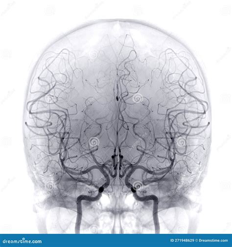 Cerebral Angiography Image From Fluoroscopy In Intervention Radiology