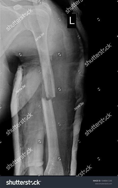 Xray Image Show Closed Fracture Left Stock Photo 1048061230 | Shutterstock