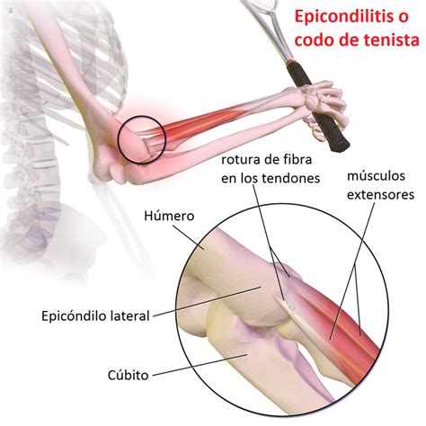 EPICONDILITIS O Codo Del Tenista