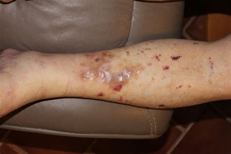 Skin Lesions Lower Leg