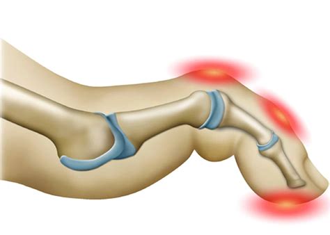 Les chirurgies du pied Institut Niçois du Sport et de l Arthrose à