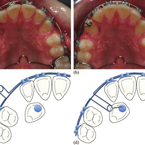 A Transpalatal Arch Used To Initiate Movement Of The Canine Prior To