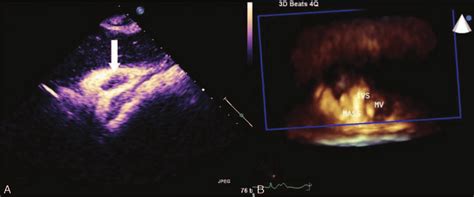 Contrast Enhancement Ultrasound Findings Show Few Contrast Agent