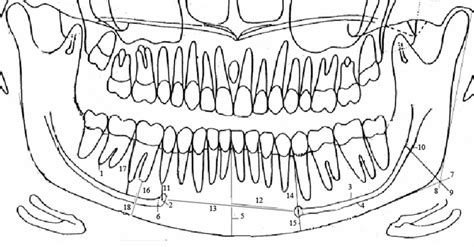 Figure From Radiographic Localization Of The Mental Foramen And