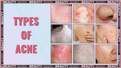 4 Types Of Acne 😱 Know Which Type Of Acne You Have Youtube