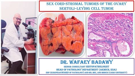 Sex Cord Stromal Tumors Of The Ovary Sertolileydig Cell Tumor By Dr Wafaey Badawy Youtube