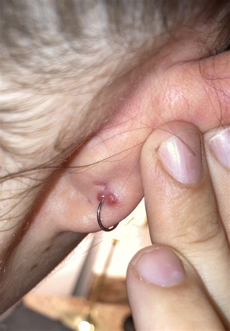 Infected Ear Cartilage Piercing