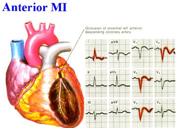 Anterior Wall Myocardial Infarction ECG