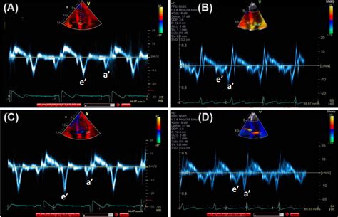 Changes In Cardiac Structure And Function With Aging