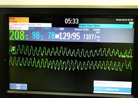 What Are The Shockable Rhythms (and Why)?