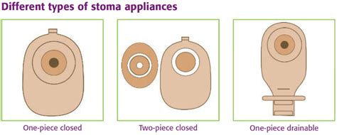 Ileostomy Loop Ileostomy End Ileostomy Diet Complications