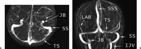 Temporal Bone Vascular Anatomy Anomalies And Disease With An