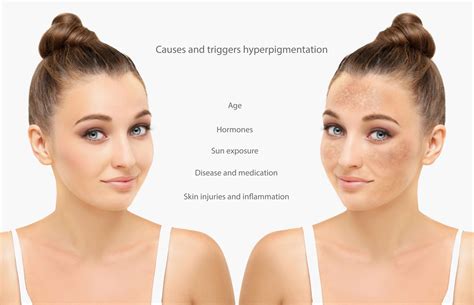 Chemical Peel For Hyperpigmentation How It Works Image Perfect Laser