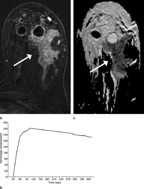 Findings In Right Breast Of 43 Year Old Woman With Recent Diagnosis Of Download Scientific