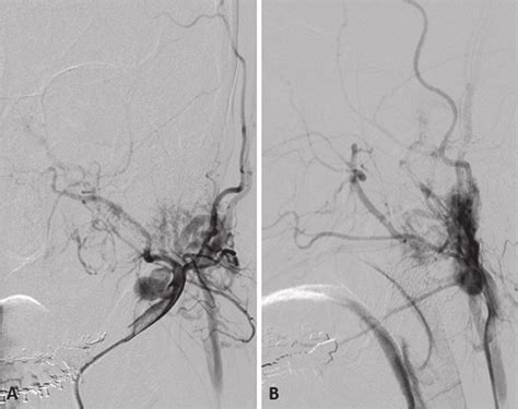 Preoperative Left External Carotid Angiogram Shows Two Aneurysms And An Download Scientific