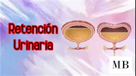 Retención Urinaria Medicina Brothers YouTube