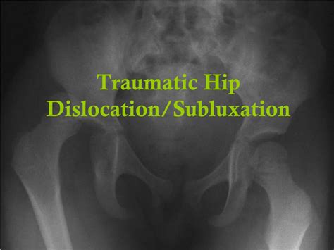 PPT - Traumatic Hip Dislocation/Subluxation PowerPoint Presentation ...