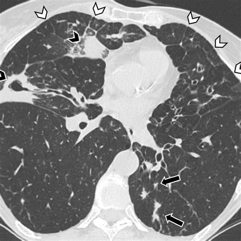 Axial Ct Image Shows Extensive Bilateral Thickwalled Bronchiectasis