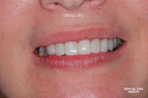 Carillas De Porcelana Cl Nica Dental Das Group Argentina