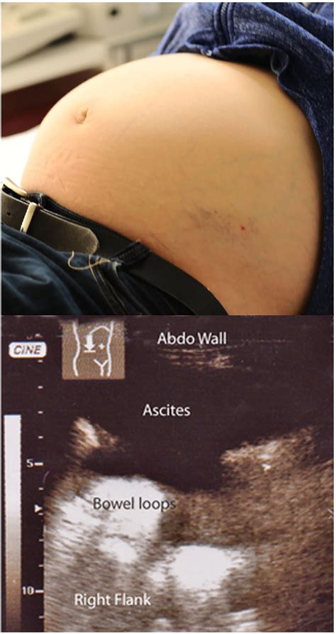 Figure From Bedside Ultrasonography Prior To Abdominal Paracentesis