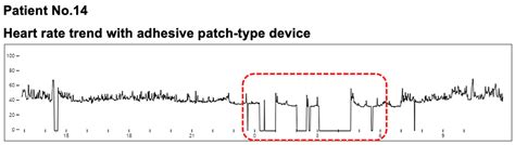 Sensors Free Full Text Validation Of Adhesive Single Lead Ecg Device Compared With Holter