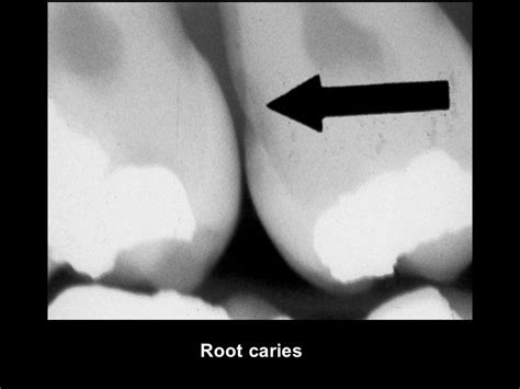 Radiographic Caries Diagnosis