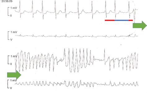 Monitorización del paciente 1 Ritmo de fibrilación auricular en el