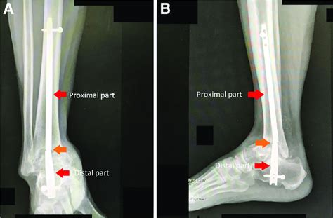 Plain Radiographs A Anteroposterior View B Lateral View Of The