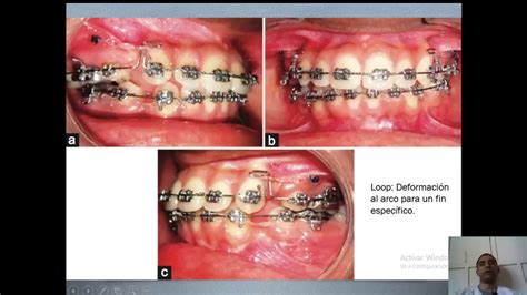 Sabes Con Qu Instrumentos El Ortodoncista Hace Dobleces En Los