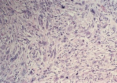 Pathology Outlines Sarcomatoid Carcinoma