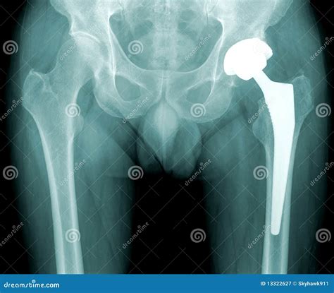 Hip X Ray With Replacement Of The Joint Stock Image Image Of Joint White 13322627