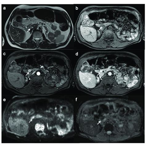 Small Functioning Pancreatic Neuroendocrine Tumor T Weighted Mr Image