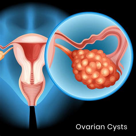 Dermoid Cyst Ovary