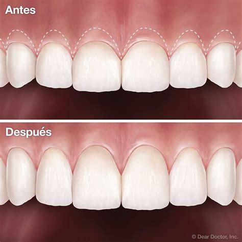 Patient Education Austin Tx Dentist Advanced Smiles Dental Pa