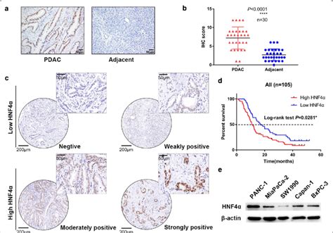 Hnf Expression Is Increased In Pdac Tissues A Representative Images