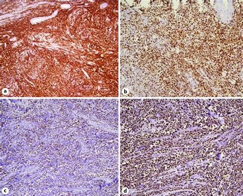 Immunochemistry Of The B Cell Lbl The Neoplastic Cells Are Positive