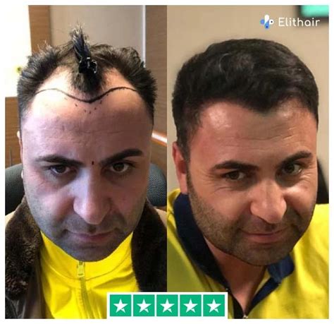 Injerto Capilar En Turqu A Elithair Tus Expertos En Estambul