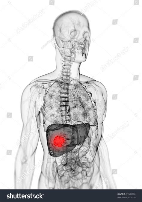 3d Rendered Scientific Illustration Liver Tumor Stock Illustration 97431920 Shutterstock